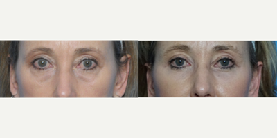 45-54 year old woman treated with Eyelid Surgery - Lower lid Blepharoplasty