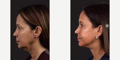 Woman treated with Facelift - Woman treated with Facelift