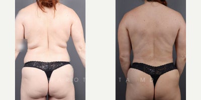 Woman treated with Renuvion - Woman treated with Renuvion
