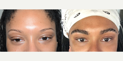 25-34 year old woman treated with Eyebrow Transplant - This Black female achieved excellent results with an eyebrow transplant of 300 grafts per side.