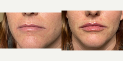 35-44 year old woman treated with Lip Fillers, Juvederm, Vollure - Patient received 1cc of Vollure to the lips