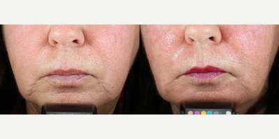 65-74 year old woman treated with Vivace - 67 year old woman treated with Vivace for skin texture, marionette lines and nasolabial folds. 3 treatments, spaced 1 month apart. Photos are 1 month post-last treatment
