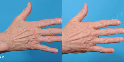 65-74 year old woman treated with Radiesse - Hand rejuvenation with 1.5cc Radiesse/hand