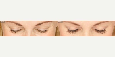 Woman treated with Latisse - Latisse