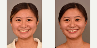 Woman treated with Buccal Fat Removal - Woman treated with Buccal Fat Removal and Cheek Liposuction to reduce chubby cheeks and achieve a more defined appearance