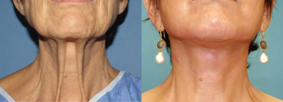 55-64 year old woman treated with Neck Lift - Neck bands don't just go away with a little pulling from the side. It is one of the trickiest things in plastic surgery to do properly. The bands must be cut and then sutured together.