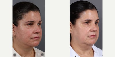 Woman treated with Deep Plane Facelift, Neck Lift, Eyelid Surgery, Facial Fat Transfer - Woman treated with Deep Plane Facelift, Neck Lift, Eyelid Surgery, Facial Fat Transfer