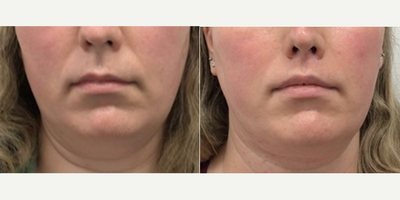 35-44 year old woman treated with Jaw Surgery - Mandible Contouring