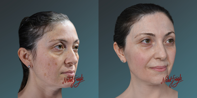 35-44 year old woman treated with PicoSure - In skin rejuvenation, laser protocols with various wavelengths now offer different solutions for treating spots and scars. Considering the ratio of skin issues such as spots, veins, keratosis, freckles, warts, moles, etc., along with skin color, age, and environmental damage.