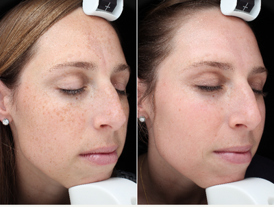 35-44 year old woman treated with Halo Laser - After 1 Halo and BBL Treatment