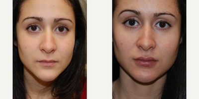 Lip Implants - Lip Implants