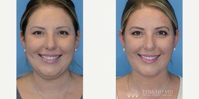 25-34 year old woman treated with Mini Neck Lift, Buccal Fat Removal - 34 year-old female who underwent buccal fat removal and deep mini neck lift for facial contouring as well as jawline contouring and neck rejuvenation.