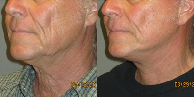 55-64 year old man treated with Neck Lift - This 60+ year old gentleman had spent most of his working career outside exposed to the damaging rays of the sun.  He presented with severe solar damage to the skin of his neck along with significant laxity.  After consultation and examination we decided to proceed with a necklift and lower facelift.  His procedure tightened both the muscle (platysma) and skin of his neck along with his jawline.