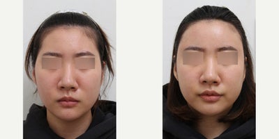 35-44 year old woman treated with Nonsurgical Facelift - Chief Complain: - Narrow forehead in comparison to the rest of the face, hollowed temples, creating a disproportionate appearance with more prominent cheeks.Treatment Plan: 1 session of fat transfer with PRP Outcome: A smooth and well-contoured forehead line, with natural volume restoration. The temples will be filled, reducing the imbalance between the upper and lower portions of the face, resulting in a more harmonious facial profile.