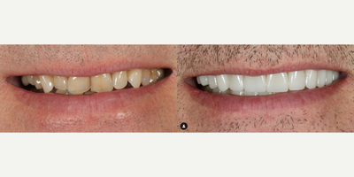 Man treated with Porcelain Veneers, Dental Crown - After years of having bonding done over and over again to his chipped edges, our patient realized bonding was temporary and putting a bandaid on his bite issues.He sought out a provider who knew more about occlusion and proper bite functioning to help him.24 porcelain veneers and crowns were completed to help correct damage down from a collapsing bite.Shade: BL3 HT