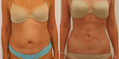 Abdominal Liposuction - Patient's goal was to reduce belly fat to accentuate her natural curves. She received abdominal liposuction and bilateral flank liposuction with SlimLipo to achieve a more toned figure.