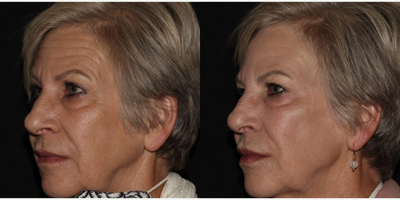 Woman treated with Emface - Emface