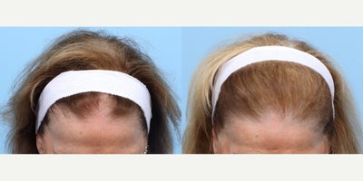 65-74 year old woman treated with PRP for Hair Loss, PRP Injections, Hair Loss Treatment - A 65-year-old patient with a history of androgenic alopecia came to Dr. Wise looking for a hair restoration treatment that would best suit her. She had experienced progressive hair thinning and recession of the frontal hairline, leading to significant cosmetic concern. Dr. Wise performed 3 sessions of PRP therapy, spaced one month apart each on this patient to promote hair growth and awaken dormant hair follicles. Her results are shown 4 months after her 3rd session, showing a substanial amount of growth.