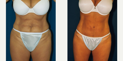 Woman treated with Mini Tummy Tuck - Woman treated with Mini Tummy Tuck