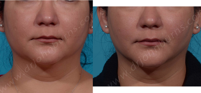 25-34 year old woman treated with Buccal Fat Removal - Before and After Buccal Fat Pad Removal