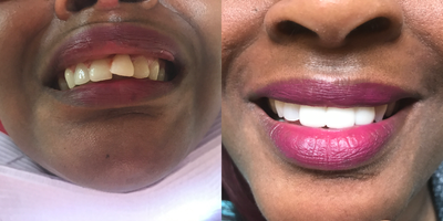 35-44 year old woman treated with Porcelain Veneers - Patient teeth looked like this for over 30 years. She finally decided to schedule a consult with Dr. Sarah Thompson. After only two visits, her life was changed.&nbsp;