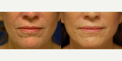 45-54 year old woman treated with Phenol Peel - Around the mouth and lips, a stronger chemical peel is used to removed deep creases that will not improve with any face lifting procedure. Often times the chemical peel is done at the same time as a facelift to allow overlap in recovery.