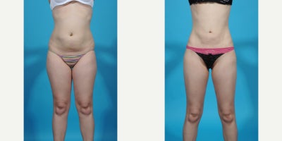 35-44 year old woman treated with Abdominal Etching, Laser Liposuction, Liposculpture, Liposuction, Power-Assisted Liposuction ( - before and after VASER ultrasound assisted liposuction abdomen/flanks; lipo 360. Liposuction is the most popular plastic surgery procedure with about 350,000 procedure done in 2023. Good candidates for liposuction have normal or near normal weight but have discrete problem areas with discrete pockets of fat. Another charateristic of a good liposuction candidate is skin quality. Younger patients with good skin quality and few stretch marks with little to no overhang or excess skin are the best candidates. Vaser is an ultrasound device that melts fat and tightens tissue making liposuction more precise with less bruising and swelling. In this case I did liposuction with VASER assistance removing about 1.5 from her abdomen and flank areas (Lipo 360).
