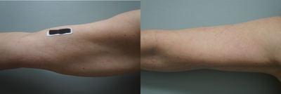 55-64 year old woman treated with Skin Tightening - BodyFX on arm area.