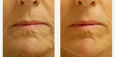 55-64 year old woman treated with Phenol Peel - The deeper the peel, the better the result, but longer the downtime. By diluting our peels, we can still achieve a great result for most fine and deep lines without an excessive downtime.