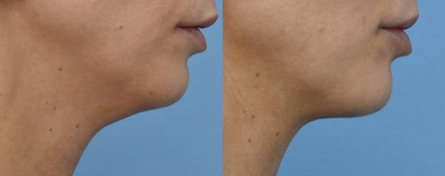 25-34 year old woman treated with Kybella - Result with two treatments of Kybella under the patients chin.