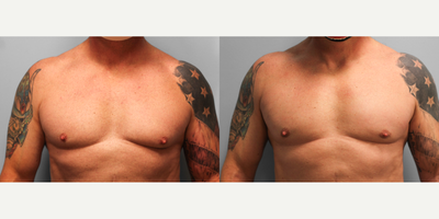 55-64 year old man treated with Gynecomastia Surgery - This healthy man in his mid-fifties was troubled by the size of her breast tissue especially on the left. He met with Dr. Tucker to discuss his concerns and options. He chose to proceed with SmartLipo of the chest with direct gland excision and he looks great pictured before and a year afterwards.