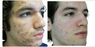 25-34 year old man treated with Spironolactone For Acne, Laser Resurfacing, CO2 Laser, YAG Laser, Fractional Laser, UltraPulse C - A safe and effective way to treat acne (even cases resistant to conventional therapies), improve the skin and minimize scar formation.What are the benefits?Laser acne treatment offers a no down-time approach to help clear acne lesions and help reduce severity of future breakouts. You can return to work or school immediately after treatment. The only side effect will be slight facial redness. Laser treatments do not have the side effects seen with oral and topical treatments. Laser treatment DO NOT induce prolonged dryness, severe redness, or mental depression.How does it work?Dr. Rafael Diaz-Yoserev will analyze your skin condition and help you select the most effective treatment for you.When will you see results?Effects are cumulative. After the first treatment, you might see improvements. The number of lesions and severity of breakouts should reduce over the course of treatments and beyond. Some patients continue to improve two months after their last treatment.How often can you have it done?The typical course of treatments is 2-3 weeks, 2-3 treatments per week.