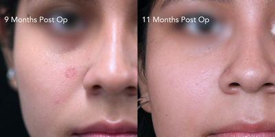 18-24 year old Female Treated with Vbeam - An 18-24 year old female treated with vascular laser (vbeam) to address redness post laser mole ablation.