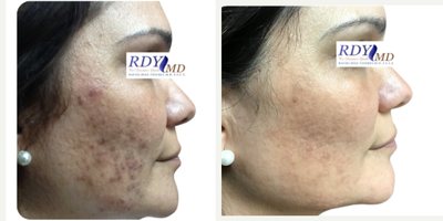 35-44 year old woman treated with Spironolactone For Acne, YAG Laser, Laser Resurfacing, CO2 Laser - A safe and effective way to treat acne (even cases resistant to conventional therapies), improve the skin and minimize scar formation.What are the benefits?Laser acne treatment offers a no down-time approach to help clear acne lesions and help reduce severity of future breakouts. You can return to work or school immediately after treatment. The only side effect will be slight facial redness. Laser treatments do not have the side effects seen with oral and topical treatments. Laser treatment DO NOT induce prolonged dryness, severe redness, or mental depression.How does it work?Dr. Rafael Diaz-Yoserev will analyze your skin condition and help you select the most effective treatment for you.When will you see results?Effects are cumulative. After the first treatment, you might see improvements. The number of lesions and severity of breakouts should reduce over the course of treatments and beyond. Some patients continue to improve two months after their last treatment.How often can you have it done?The typical course of treatments is 2-3 weeks, 2-3 treatments per week.