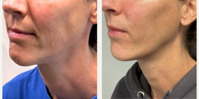 35-44 year old woman treated with Thread Lift, Contour Thread Lift - She presented concerned that her face felt heavier, as you can see she has a petit face with beautiful bone structure. She felt she had with deepening nasolabial folds and early jowl formation. We performed a customized thread lift to reposition and elevate the midface and lower face, restoring structural support. The result is a lighter, more contoured appearance with improved jawline definition and balanced facial harmony.