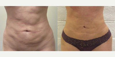 Woman treated with BodyTite - This patient received the following procedures:AbdomenBackBrazilian Butt LiftCellulite, Liposuction Revision, And Fat GraftingLiposuction Revision