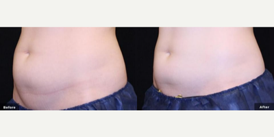 Woman treated with truSculpt iD - Woman treated with truSculpt iD