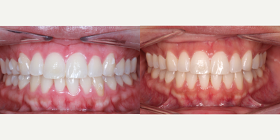 25-34 year old woman treated with InBrace - This patient came to us with crowding and had Invisalign before but was not happy with the way how her smile was. The dentistdecided to do lingual braces with Inbrace. They are the type of braces that goes behind the teeth rather than having the braces on full display.
