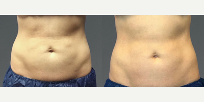 Man treated with CoolTone - Man treated with CoolTone