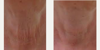 55-64 year old woman treated with Pixel Laser - Pixel RF uses proprietary InMotion Refractive Radiofrequency MicroPlasma Technology, which both ablates and heats the skin through controlled, focused delivery of energy. Healthy skin around the treated area helps to accelerate the healing process thus improving results and reducing patient down time by allowing the need for just the targeted tissue to heal and collagen to strengthen. With its high-energy output, it achieves results even after one treatment. Not only is it highly effective to use on all skin types, but treatment can be administered year-round with no seasonal restrictions. Unlike dermal rollers or low power bi-polar RF applicators that superficially ablate the heat the skin, the Pixel RF causes evaporation, mechanical damage and thermal damage deep beneath the epidermis surface providing significant dermal impact with minimal epidermal disruption.Each treatment will take approximately 20 minutes, with one hour to topically numb the skins surface. Generally, treatment involves 4-6 treatments, 4 week apart.