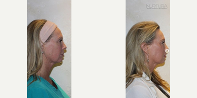 Nuface - The Nu Skin Rejuvenation Procedure utilizes your own regenerative (stem) cells and fat tissue to replace voume loss in the face and body.