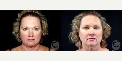 58 year old woman treated with Thread Lift - 58 year old woman treated with Thread Lift .Photos depict before and 3 months after 6 Instalift Sutures.