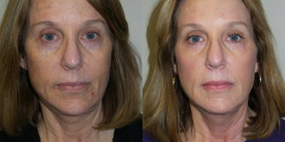 64 year old woman treated with Profound RF - 64 year old female treated with Profound RF to lower face and neck.