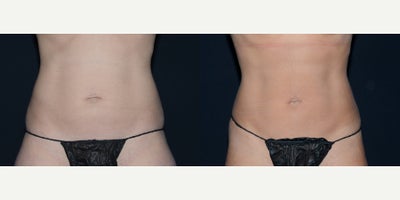 39 year old woman treated with Liposuction Revision - 39 year old woman treated with Liposuction to 360 Abdomen and inner/outer thighs. Photos depict before and 1 month after surgery.
