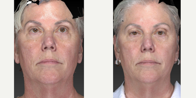 65-74 year old woman treated with Microdermabrasion - Tyte & Bryte laser procedure to rejuvenate this woman's face.