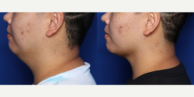 Woman treated with FaceTite - Woman treated with FaceTite