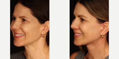 Woman treated with Neck Lift - She's 7 weeks out from facial rejuvenation surgery looking absolutely stunning...As you can see, this beautiful patient did not have significant jowling or deep wrinkles to begin with, and she's on the younger end of the facial rejuvenation demographic. But she wanted a change.This is becoming more and more common in my practice; younger patients (women in their late 30's or early 40's) consulting with me for facial rejuvenation. Surgical techniques for the face have improved dramatically over the past decade, allowing younger patients with relatively mild facial aging to achieve these types of results. Previously the techniques weren't powerful enough to generate a substantial outcome for younger patients. That is no longer true.For my patient I did an extended deep plane facelift and necklift, lip lift, and a subtle temporal lift. At this early stage she is still swollen and her incisions remain red but I'm already in love with this result. The best part is she still looks like herself.