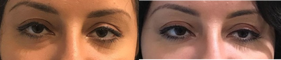 25-34 year old woman treated with Belotero - My 27-year-old patient 2 weeks after Belotero filler to the under eye, Restylane Lyft to the cheeks, and Restylane to the lips. She has received many compliments at work and they arent sure why she looks better.