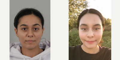 18-24 year old woman treated with AccuLift, Cheekbone Reduction, Facial Fat Transfer, Nonsurgical Facelift, Rhinoplasty, V Line  - .