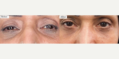 Woman treated with Mesotherapy - Are you tired of those pesky dark circles under your eyes? Say hello to White In Mesotherapy - the exclusive solution to all your skin discoloration problems!